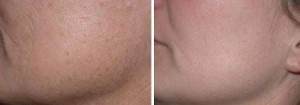 pre and post microdermabrasion